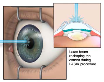 Lasik Eye Surgery